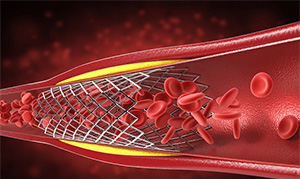 If Coronary Stenosis is ≥ 50% and ≤ 70%, Should a Stent Be Placed?