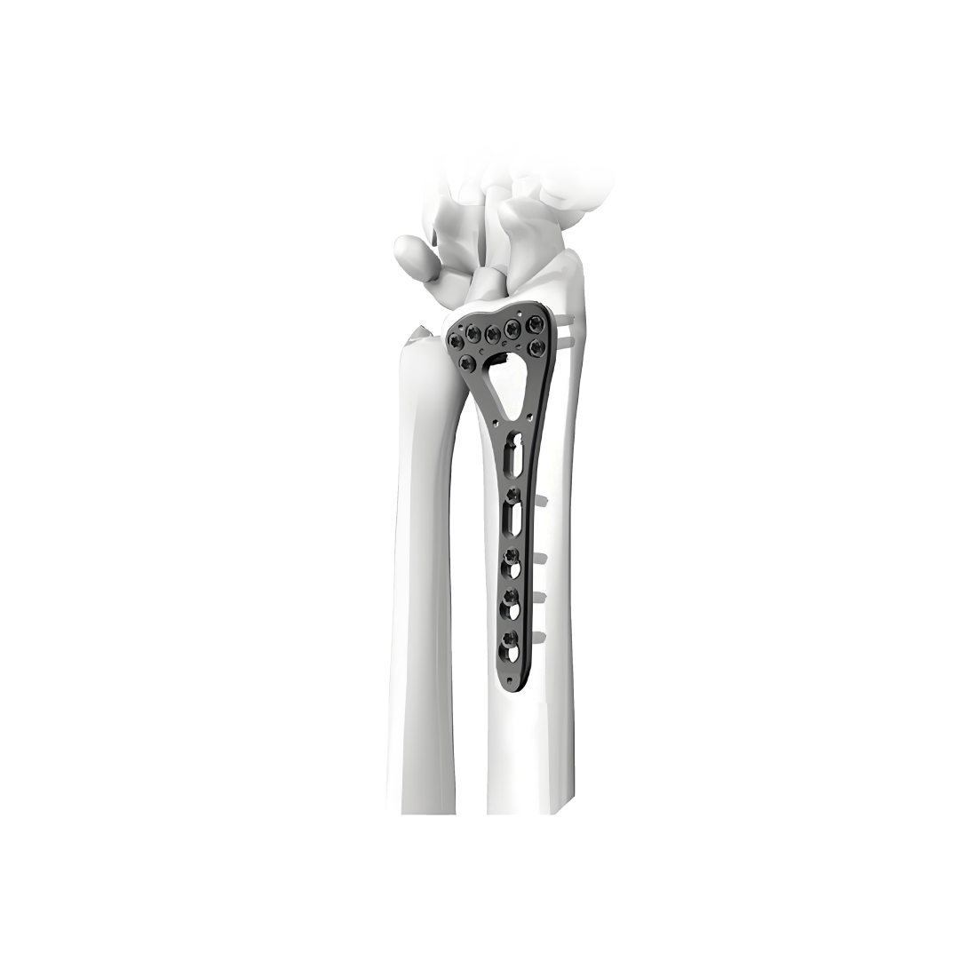 Volar Distal Radius Locking Compression Plate (I)